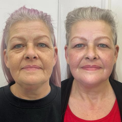 Brazilian Facelift