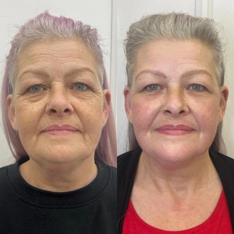 Brazilian Facelift