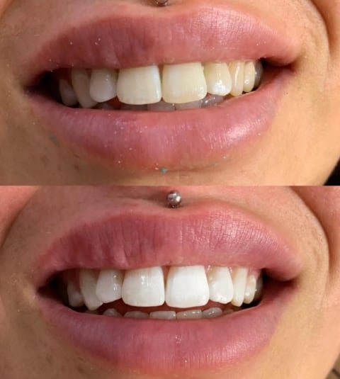 Teeth Whitening