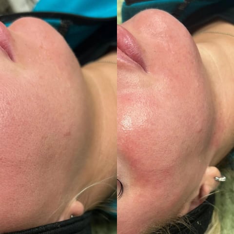 Chemical Peels