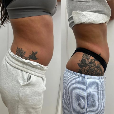Tummy Sculpting